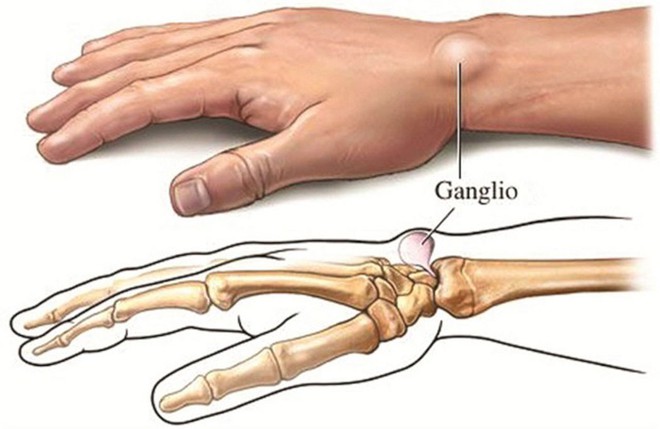 6 dấu hiệu cảnh báo sớm bệnh ung thư xương mà bạn không nên chủ quan bỏ qua - Ảnh 2.