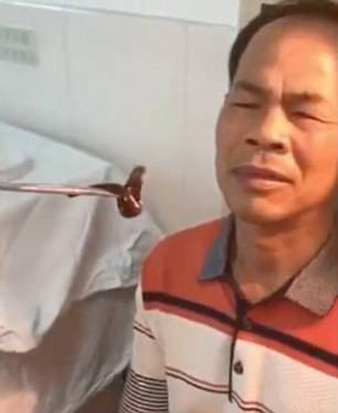 Trung Quốc: Ông chú đi khám mũi đau lâu ngày không khỏi, bác sĩ lôi ra nguyên con đỉa lớn đang 'ở nhờ' bên trong - Ảnh 2.