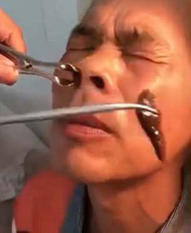 Trung Quốc: Ông chú đi khám mũi đau lâu ngày không khỏi, bác sĩ lôi ra nguyên con đỉa lớn đang 'ở nhờ' bên trong - Ảnh 2.
