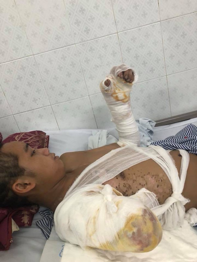 Bố chết mẹ bỏ đi biền biệt, ch&agrave;ng trai đang một m&igrave;nh nu&ocirc;i 5 em nhỏ bỗng bị điện giật cụt tay, sống lay lắt - Ảnh 3.