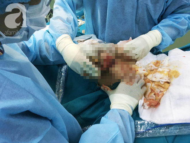 Sang Thái Lan bơm “mỡ nhân tạo”, nữ Việt kiều bị hoại tử ngực nặng - Ảnh 2.