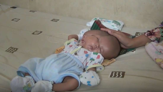 B&eacute; trai Indonesia mắc dị tật hiếm gặp nhất: sinh ra với 2 khu&ocirc;n mặt v&agrave; 2 bộ n&atilde;o - Ảnh 1.