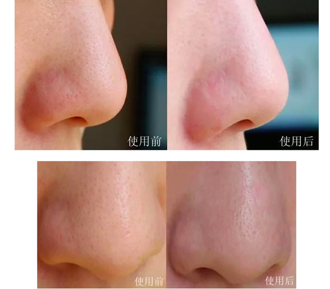 C&aacute;c mẹ chắc hẳn sẽ bất ngờ với c&ocirc;ng dụng trị mụn từ hũ kem hăm cho b&eacute; gi&aacute; chỉ hơn 200 ng&agrave;n - Ảnh 11.