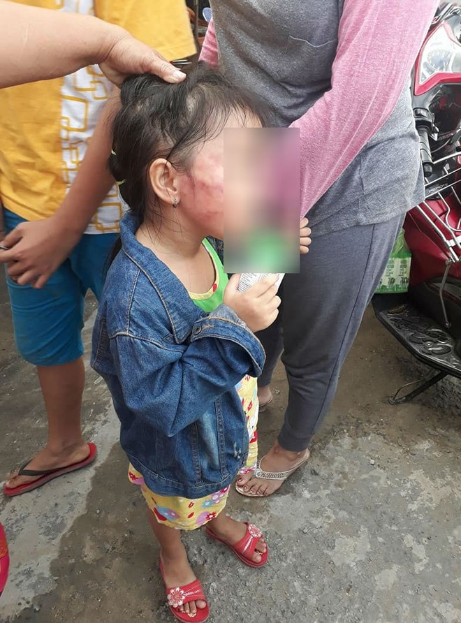 TP.HCM: Bé gái 5 tuổi nghi bị bảo mẫu tát liên tục đến sưng mặt, dọa lấy kéo cắt lưỡi nếu nói cho gia đình biết - Ảnh 1.