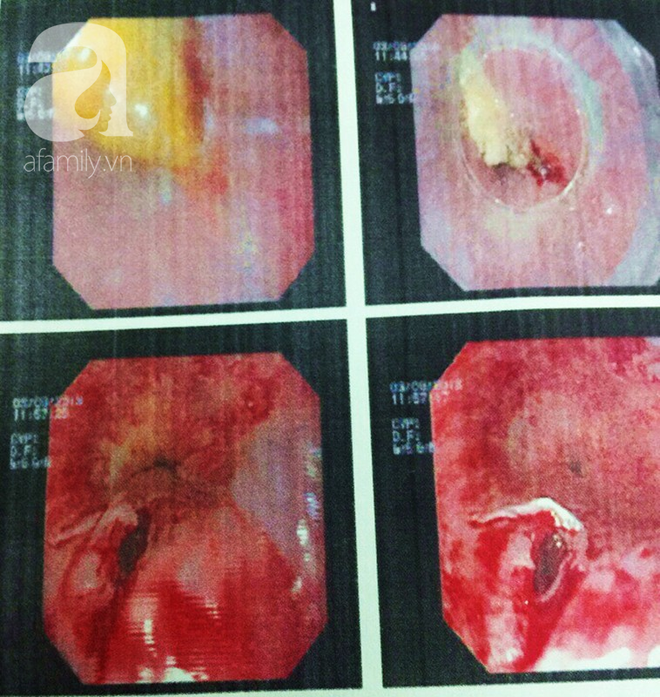 TP.HCM: Mắng con trong l&uacute;c ăn phở g&agrave;, mẹ bị h&oacute;c xương thủng thực quản - Ảnh 2.