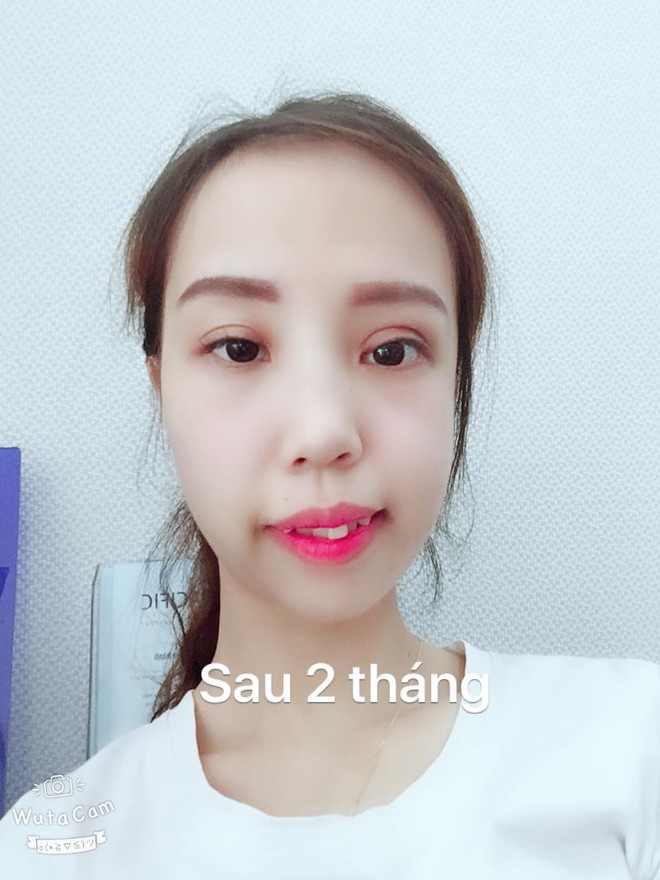 Bị bạn bè trêu chọc vì teo nửa bên mặt, cô gái Hà Nội lột xác sau phẫu thuật thẩm mỹ - Ảnh 5.