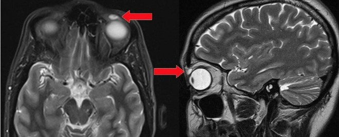 Y học cũng sửng sốt: Kính áp tròng kẹt trong mí mắt, sau 28 năm mới biết mà lấy ra - Ảnh 1.