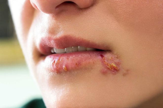 Các triệu chứng Herpes ở phụ nữ không nên bỏ qua - Ảnh 5.