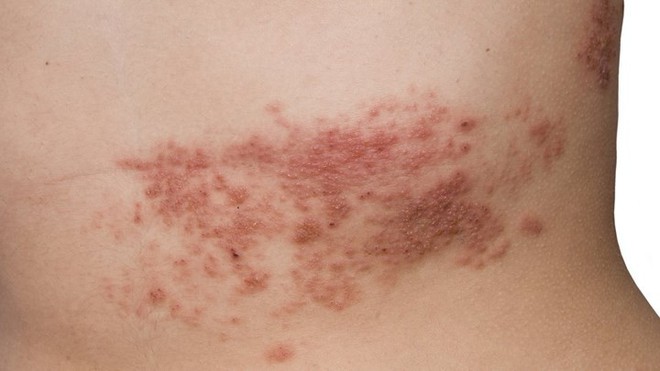 Các triệu chứng Herpes ở phụ nữ không nên bỏ qua - Ảnh 6.