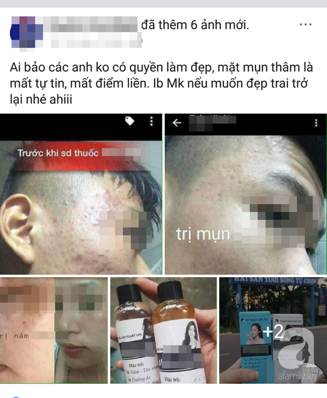 Dùng mỹ phẩm dân tộc” mong da đẹp lột xác, cô gái 19 tuổi bị biến dạng cả mặt, mắt híp lại và sưng vù kinh dị - Ảnh 8.