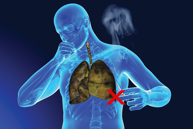 Có 20.000 người Việt Nam mắc ung thư phổi mỗi năm, nên làm gì để phát hiện sớm căn bệnh này? - Ảnh 3.