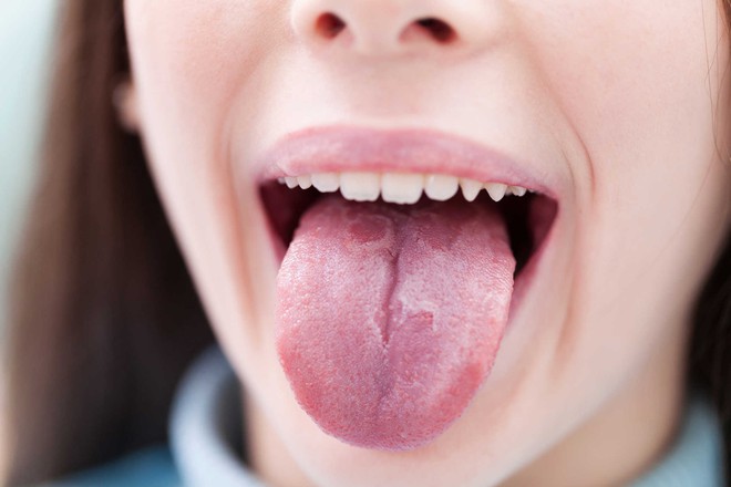 Những triệu chứng bất thường ở lưỡi c&oacute; thể cảnh b&aacute;o bạn đang mắc c&aacute;c căn bệnh nguy hiểm - Ảnh 2.
