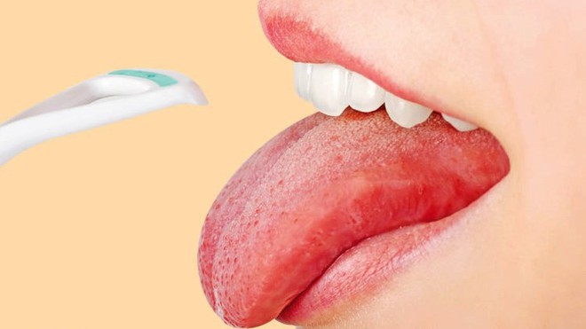 Những triệu chứng bất thường ở lưỡi c&oacute; thể cảnh b&aacute;o bạn đang mắc c&aacute;c căn bệnh nguy hiểm - Ảnh 3.