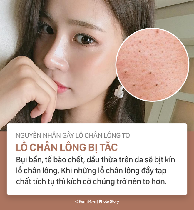 Nỗi ám ảnh lỗ chân lông to và cách làm bay biến chúng - Ảnh 3.