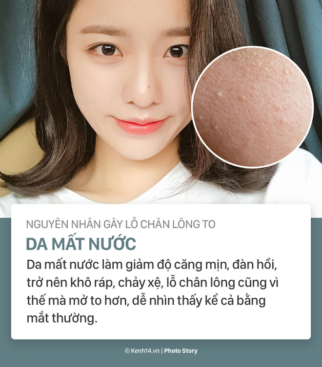 Nỗi ám ảnh lỗ chân lông to và cách làm bay biến chúng - Ảnh 5.