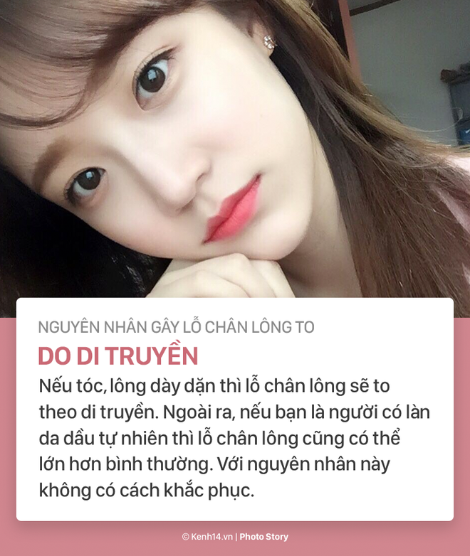 Nỗi &aacute;m ảnh lỗ ch&acirc;n l&ocirc;ng to v&agrave; c&aacute;ch l&agrave;m bay biến ch&uacute;ng - Ảnh 1.
