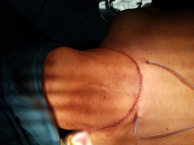 6 giờ phẫu thuật cắt bỏ khối bướu “khổng lồ” nặng 2 kg khỏi cổ người đàn ông - Ảnh 2.