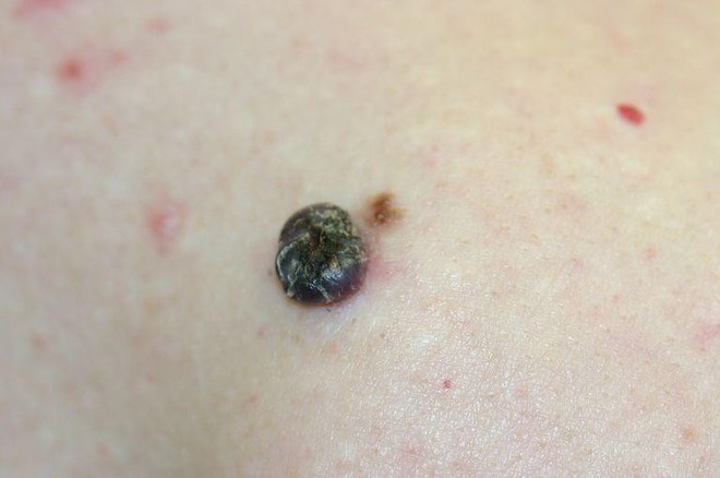 Cẩn thận với 5 dấu hiệu bất thường của nốt ruồi cũng có thể cảnh báo nguy cơ mắc bệnh ung thư da - Ảnh 5.