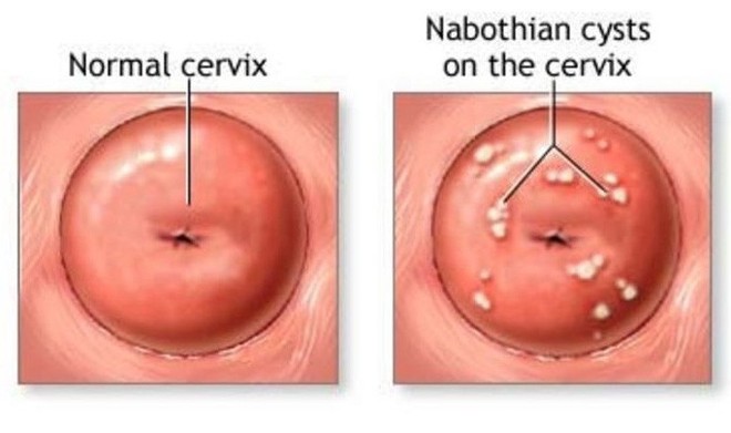 Đây là 6 căn bệnh thường gặp ở cổ tử cung mà con gái nên đặc biệt nắm rõ - Ảnh 4.