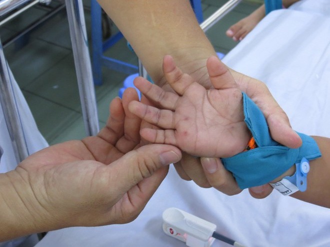H&agrave;ng trăm trẻ nhập viện v&igrave; bệnh tay ch&acirc;n miệng - Ảnh 3.