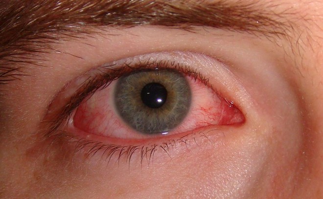 Mắt đột nhiên đỏ ngầu có thể là do 4 nguyên nhân sức khỏe mà bạn không ngờ đến - Ảnh 1.