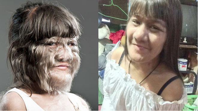 Thái Lan: Cô gái 17 tuổi giữ kỷ lục nhiều lông nhất thế giới khiến mọi người kinh ngạc khi cạo sạch lông mặt! - Ảnh 1.