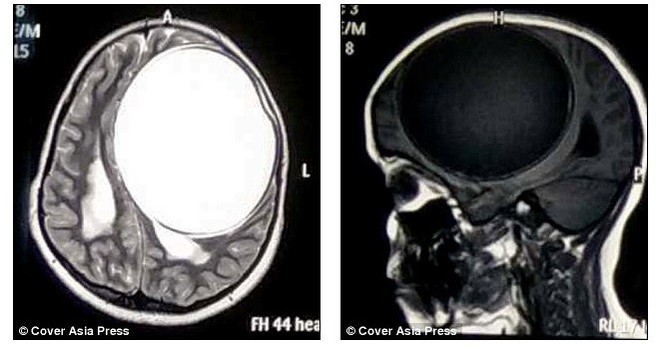 Liên tục nhức đầu, thậm chí liệt nửa người, 2 năm sau, bệnh nhân sợ hãi khi bác sĩ phát hiện thứ kinh khủng này trong não - Ảnh 2.