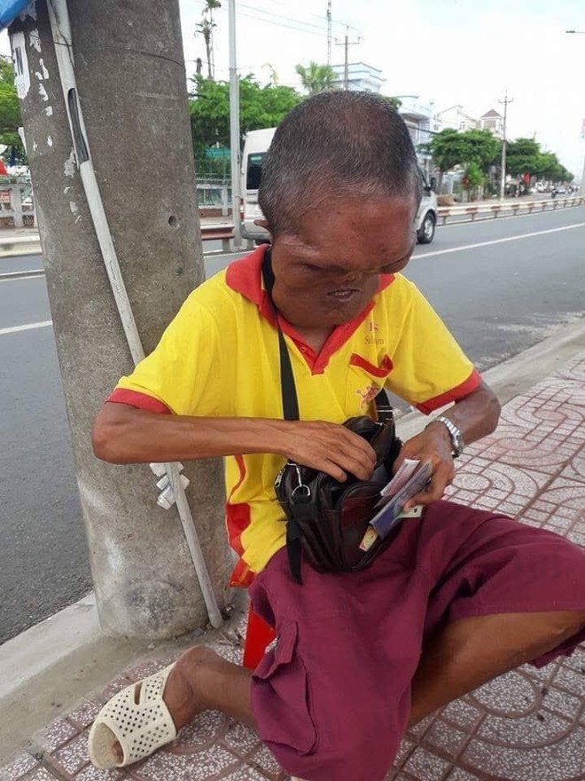 Xót xa cảnh người đàn ông bán vé số có gương mặt quỷ do mắc bệnh lạ khiến nhiều người sợ hãi chẳng dám mua - Ảnh 2.