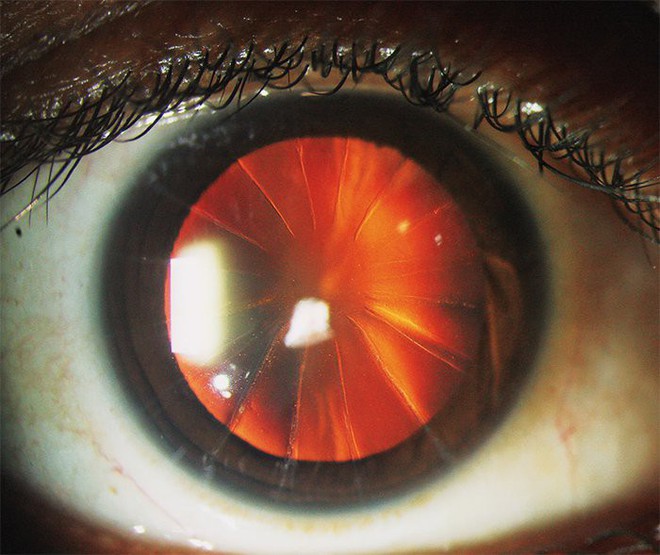 Bệnh nhân với con mắt siêu hiếm trông như bánh pizza 8 miếng: Minh chứng cho thấy y học đã từng đáng sợ như thế nào - Ảnh 1.