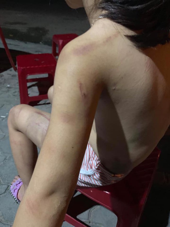 X&oacute;t xa b&eacute; g&aacute;i lớp 1 bị b&agrave; cố nội đ&aacute;nh bầm t&iacute;m khắp cơ thể - Ảnh 3.