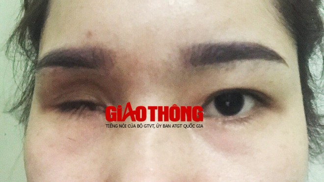 Bắc Giang: N&acirc;ng mũi tại cơ sở l&agrave;m đẹp, c&ocirc; g&aacute;i bị m&ugrave; vĩnh viễn - Ảnh 3.