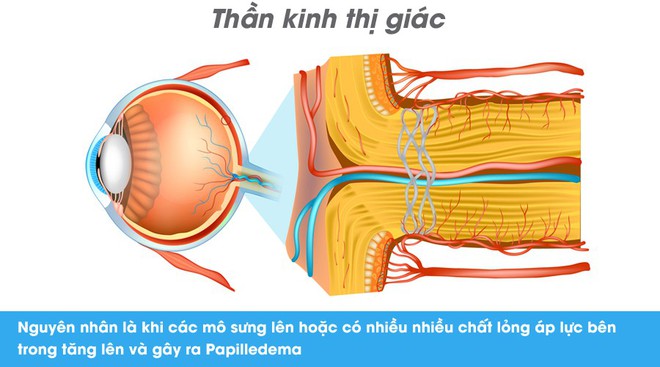 Thói quen kén ăn, chế độ ăn uống nghèo nàn có thể dẫn đến suy giảm thị lực nghiêm trọng cả hai mắt - Ảnh 3.