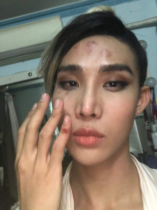 Sau VJ Kim Nh&atilde;, th&ecirc;m một người mẫu Vbiz vừa tố bị t&agrave;i xế xe &ocirc;m c&ocirc;ng nghệ đ&aacute;nh bầm mặt - Ảnh 1.