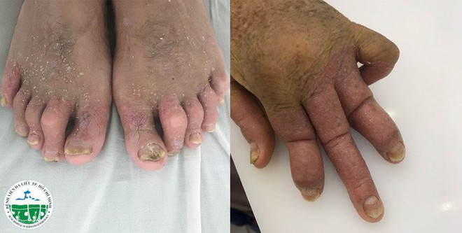  Biến dạng to&agrave;n th&acirc;n do uống thuốc thầy lang trị vảy nến  - Ảnh 1.