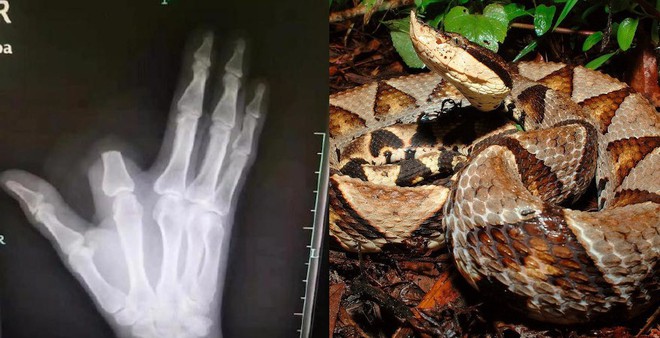 Bị rắn cắn, bác nông dân nhanh nhảu chặt phăng ngón tay nhưng đến bệnh viện thì bác sĩ bảo không cần - Ảnh 1.