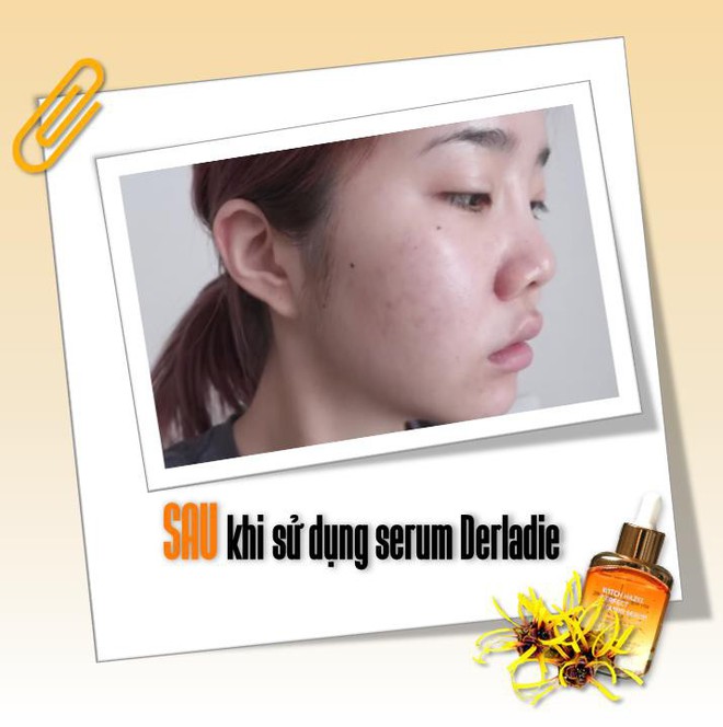 Kết quả cực bất ngờ với trải nghiệm serum giảm mụn, lấp đầy sẹo rỗ Derladie chỉ trong 14 ngày - Ảnh 3.