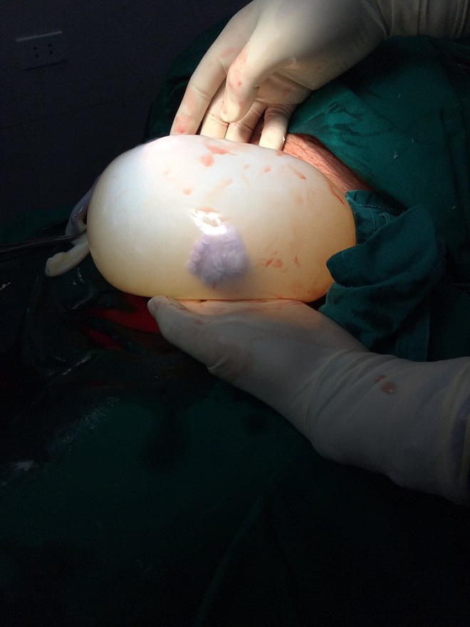 Kỳ lạ hai bé song sinh nằm gọn trong bọc ối hình trái tim - Ảnh 1.