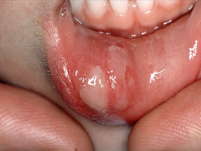 4 dấu hiệu loét miệng ngầm cảnh báo bệnh ung thư miệng đang âm thầm phát triển - Ảnh 2.