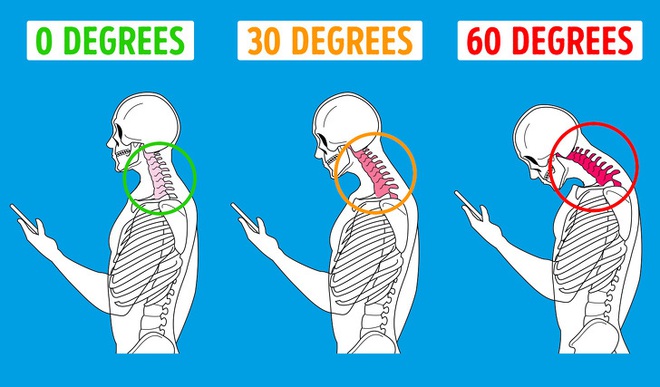 Hội chứng kỳ lạ do tư thế rất nhiều người trong chúng ta đang mắc phải trong thời đại smartphone ngập tràn thế giới - Ảnh 4.