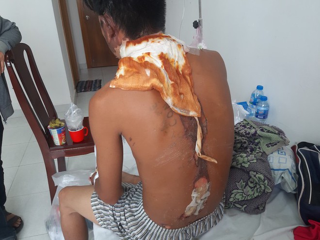 Thanh ni&ecirc;n bị chị ruột đổ nước s&ocirc;i v&agrave;o đầu - Ảnh 1.