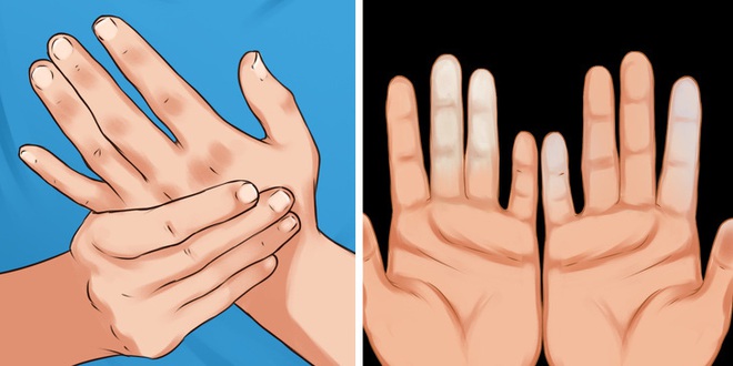 Cẩn thận với căn bệnh thường gặp phải khi trời lạnh khiến ngón tay và ngón chân của bạn đổi màu trắng xanh - Ảnh 1.