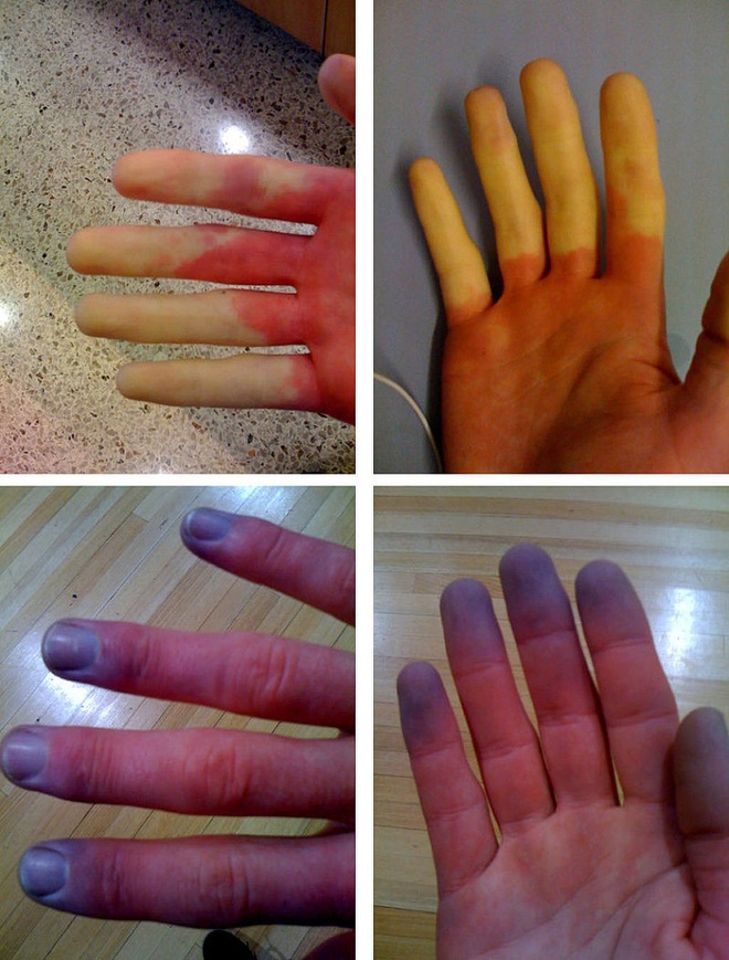 Cẩn thận với căn bệnh thường gặp phải khi trời lạnh khiến ngón tay và ngón chân của bạn đổi màu trắng xanh - Ảnh 4.