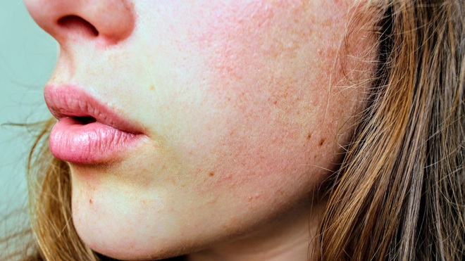 Bạn sẽ không nghĩ rằng mình có nguy cơ mắc bệnh phụ khoa khi gặp phải một trong những triệu chứng sau trên khuôn mặt - Ảnh 4.