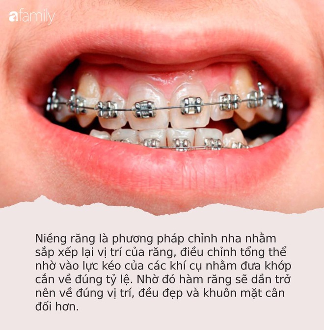 Loạt sao chứng minh sức mạnh vi diệu của niềng răng và thời điểm vàng để bạn “cứu vãn” nhan sắc nhờ chỉnh nha - Ảnh 6.