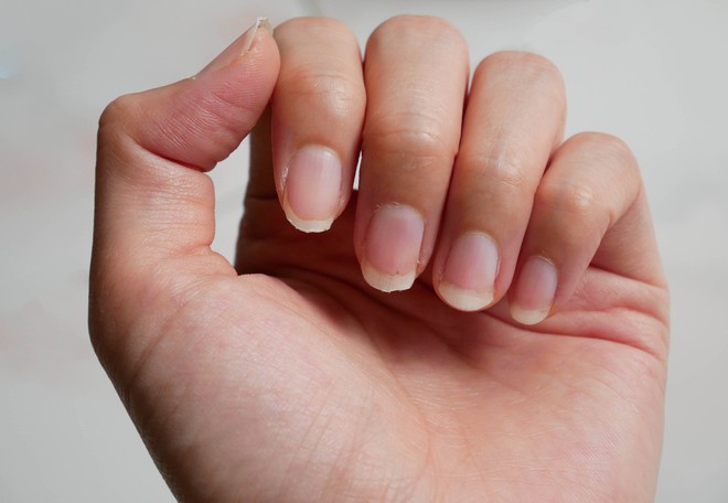 Nhìn dấu hiệu bất thường trên móng tay cũng có thể biết được bạn đang gặp phải những vấn đề sức khỏe gì - Ảnh 3.