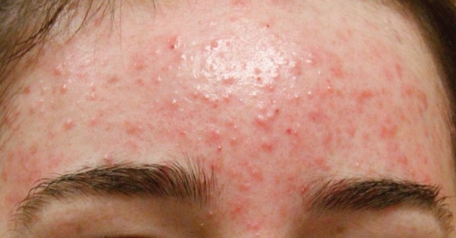Mụn xuất hiện ở nhiều vị trí trên khuôn mặt có thể là dấu hiệu cảnh báo hàng loạt vấn đề sức khỏe nguy hại - Ảnh 5.