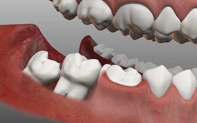 Có thể bạn đã mắc bệnh viêm nướu răng nếu gặp phải một trong các vấn đề sau - Ảnh 3.