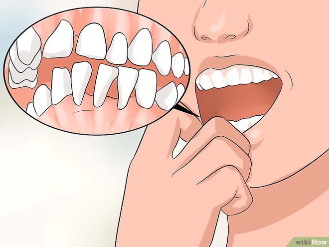 Có thể bạn đã mắc bệnh viêm nướu răng nếu gặp phải một trong các vấn đề sau - Ảnh 5.