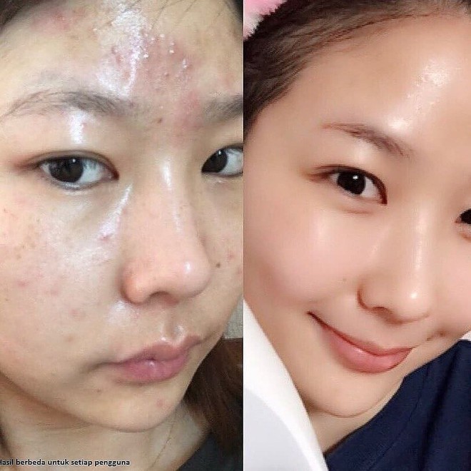 Bước đầu ti&ecirc;n khi bắt đầu trị mụn, b&aacute;c sĩ da liễu khuy&ecirc;n bạn n&ecirc;n đặc biệt quan t&acirc;m đến điều n&agrave;y - Ảnh 1.