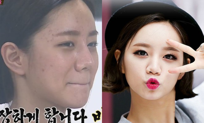 Makeup quá nhiều, loạt idol Hàn cũng khốn khổ vì mụn nhọt tùm lum - Ảnh 7.